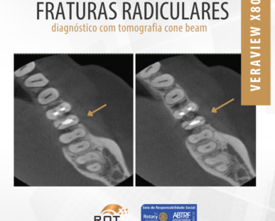 fraturas-radiculares