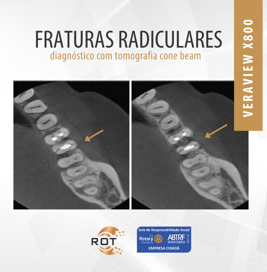 fraturas-radiculares