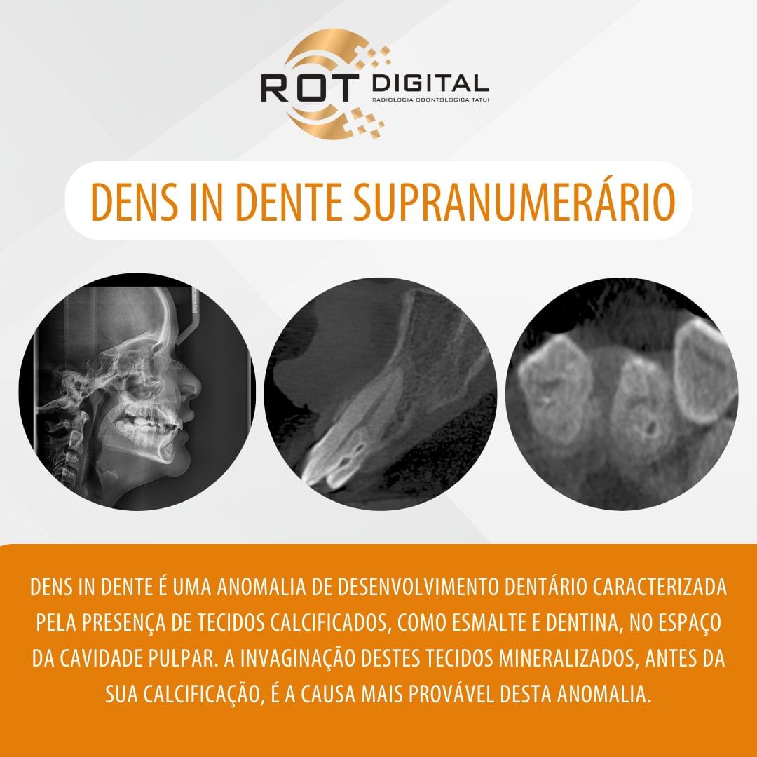 dens-in-dente-supranumerario