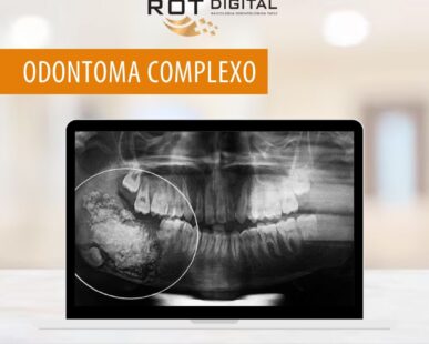 odontoma-complexo