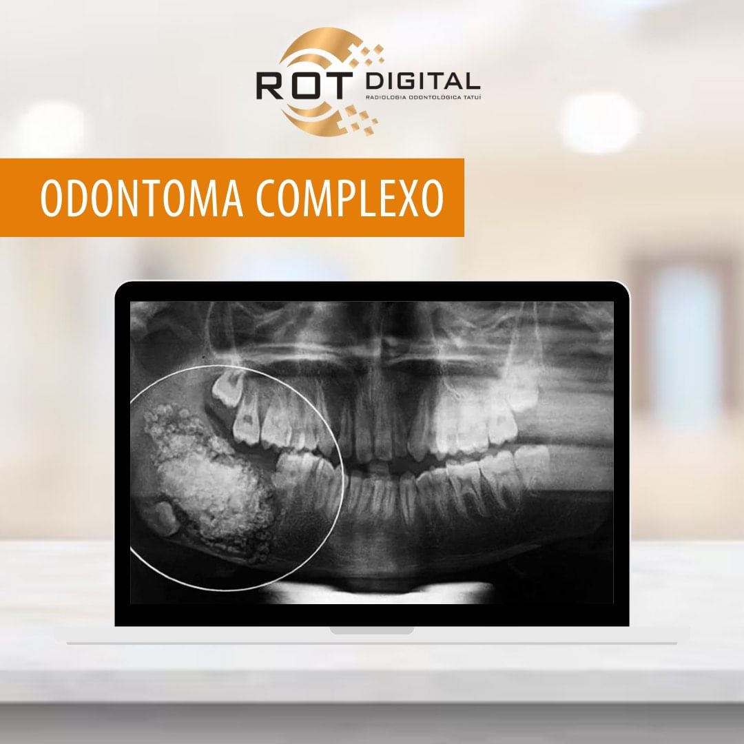 odontoma-complexo