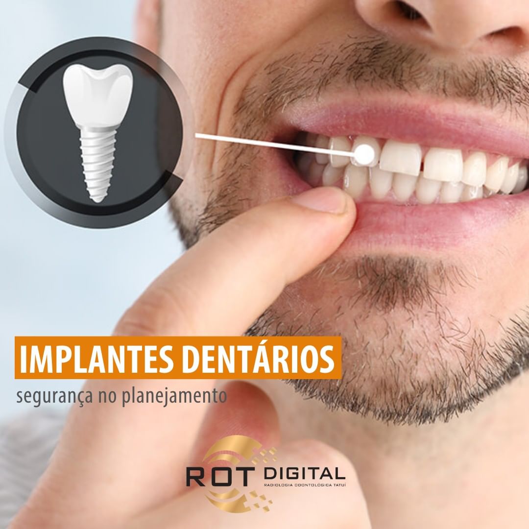 implantes-dentarios