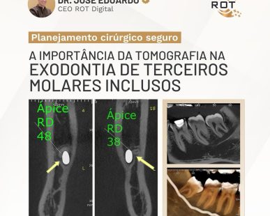 exodontia-de-terceiros-molares-inclusos