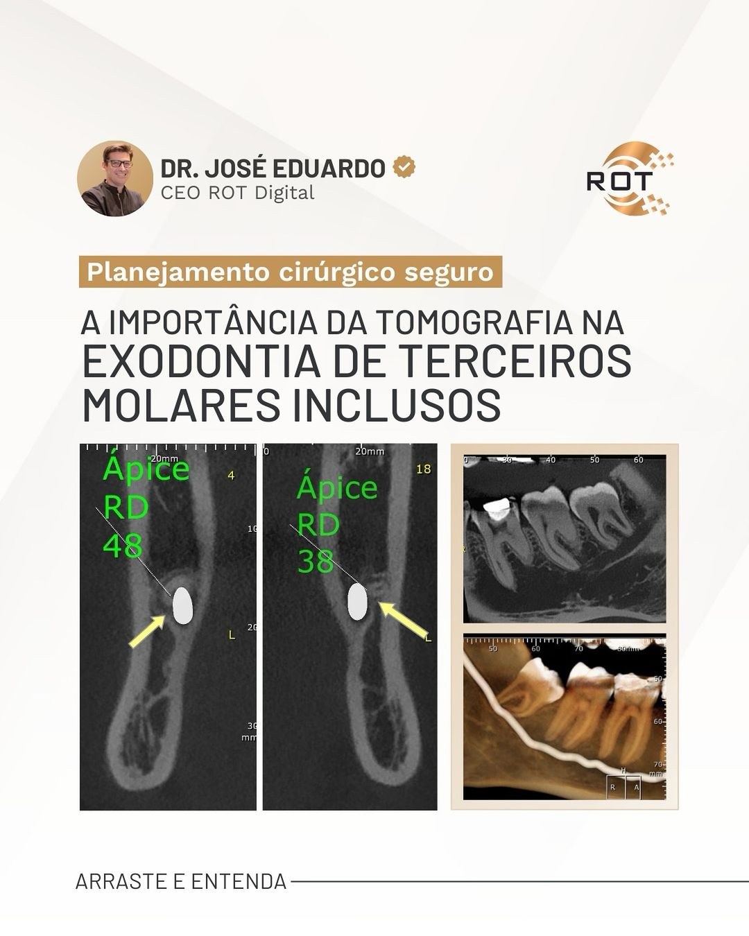 exodontia-de-terceiros-molares-inclusos