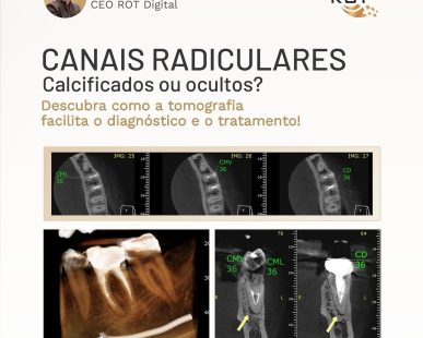 canais-radiculares