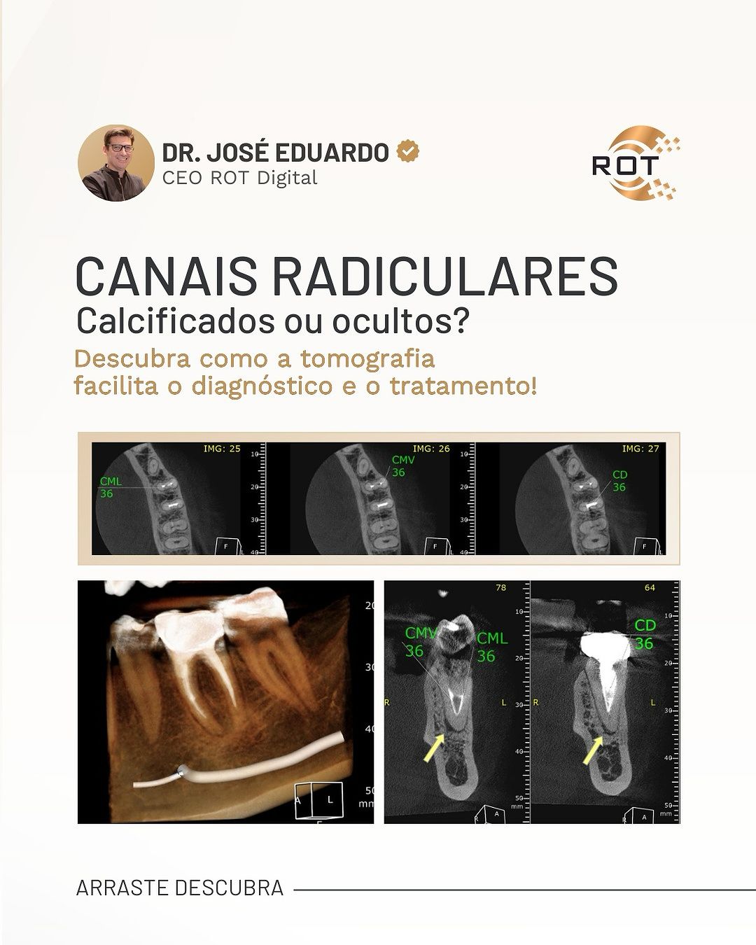 canais-radiculares