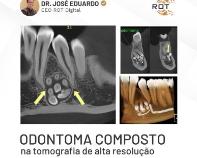 odontoma-composto