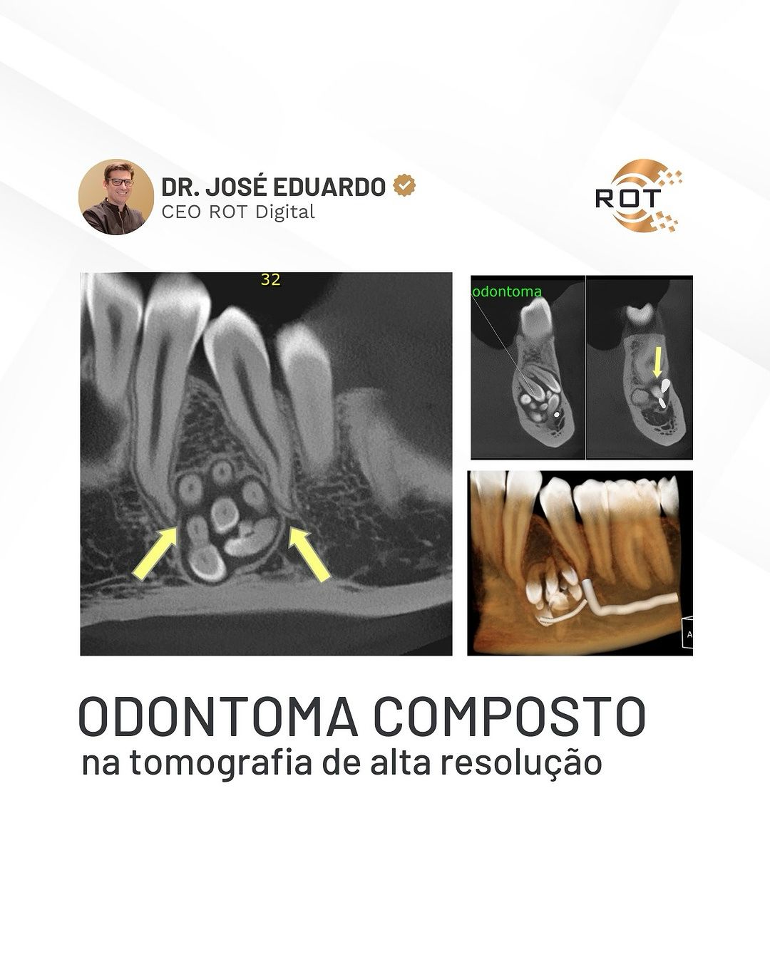 odontoma-composto