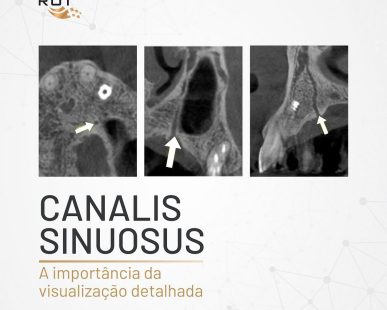 canalis-sinuosus