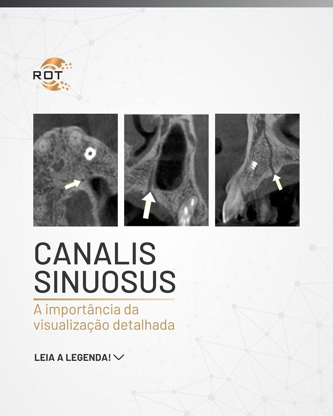 canalis-sinuosus