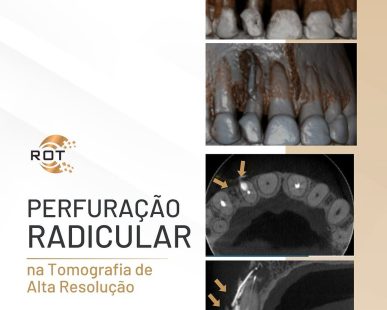 perfuracao-radicular