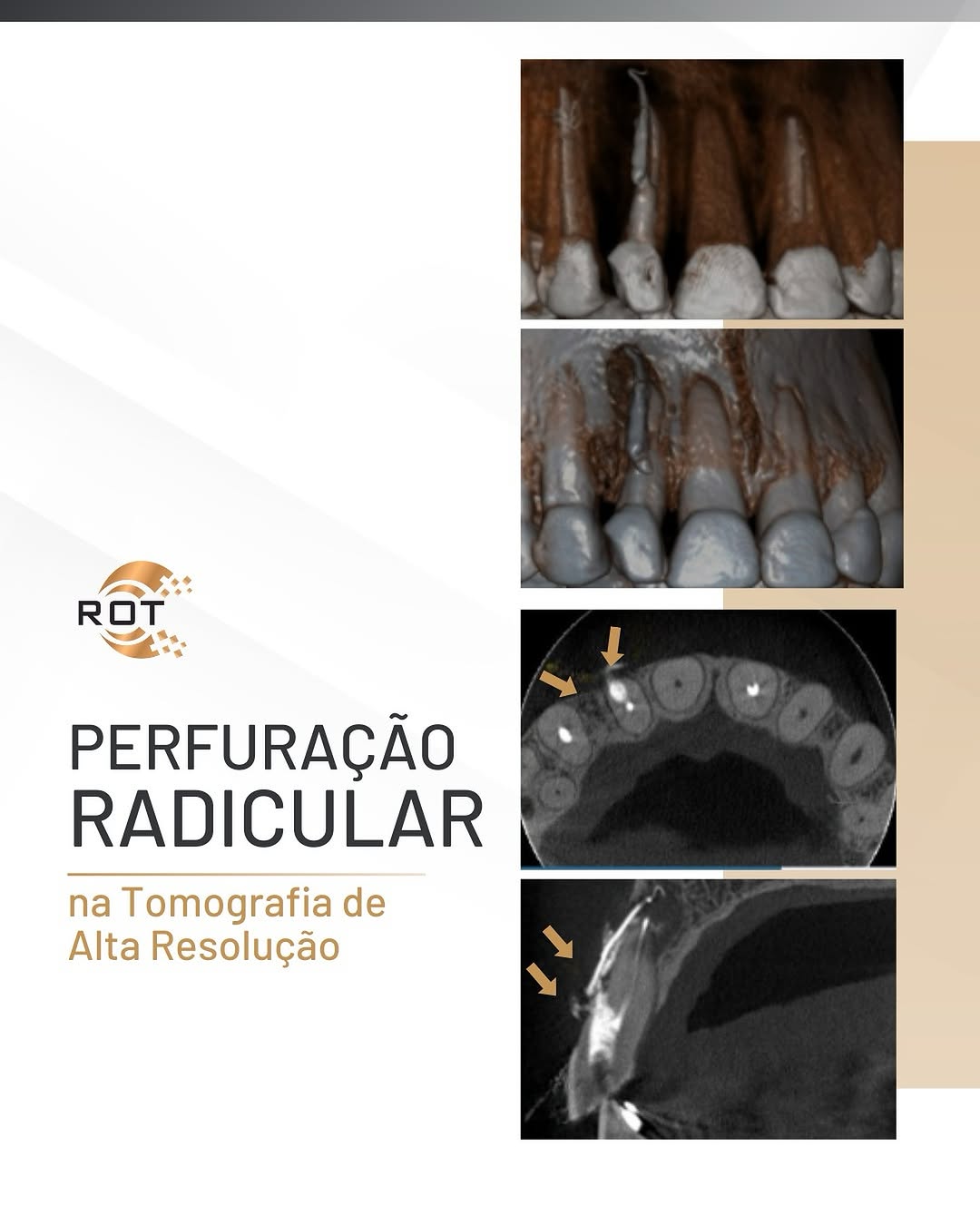 perfuracao-radicular